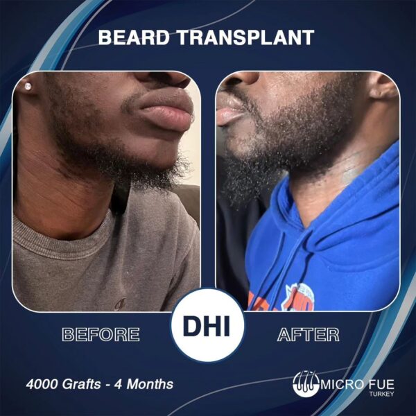 Beard Transplant Techniques