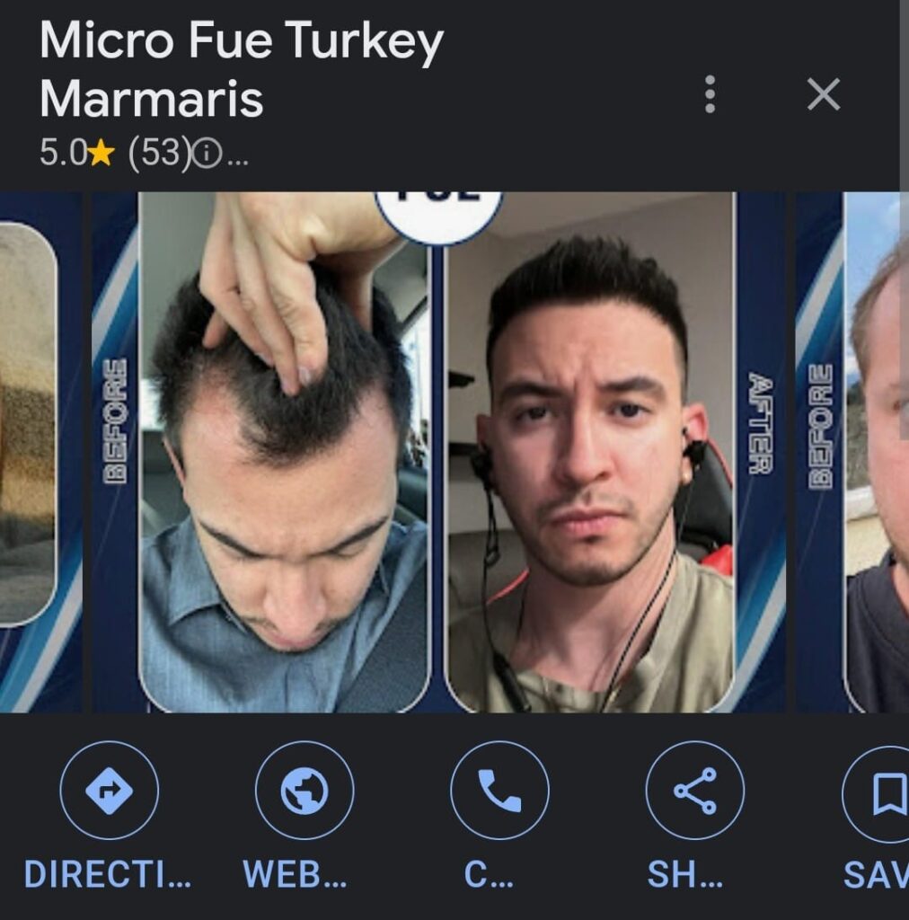 Hair transplant Turkey