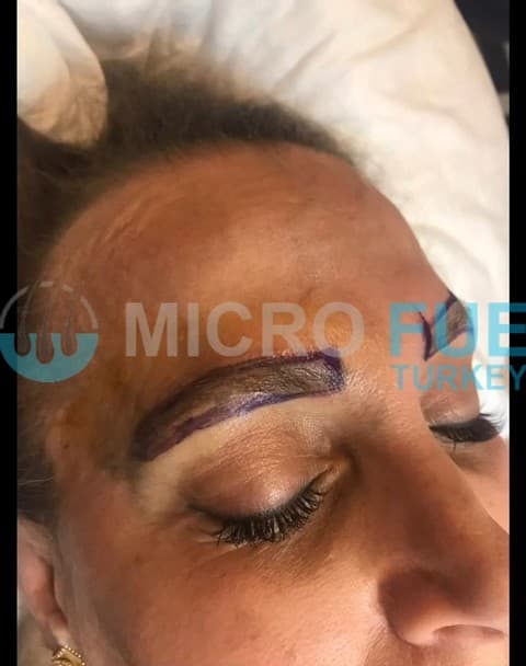 Eyebrow Transplant Techniques