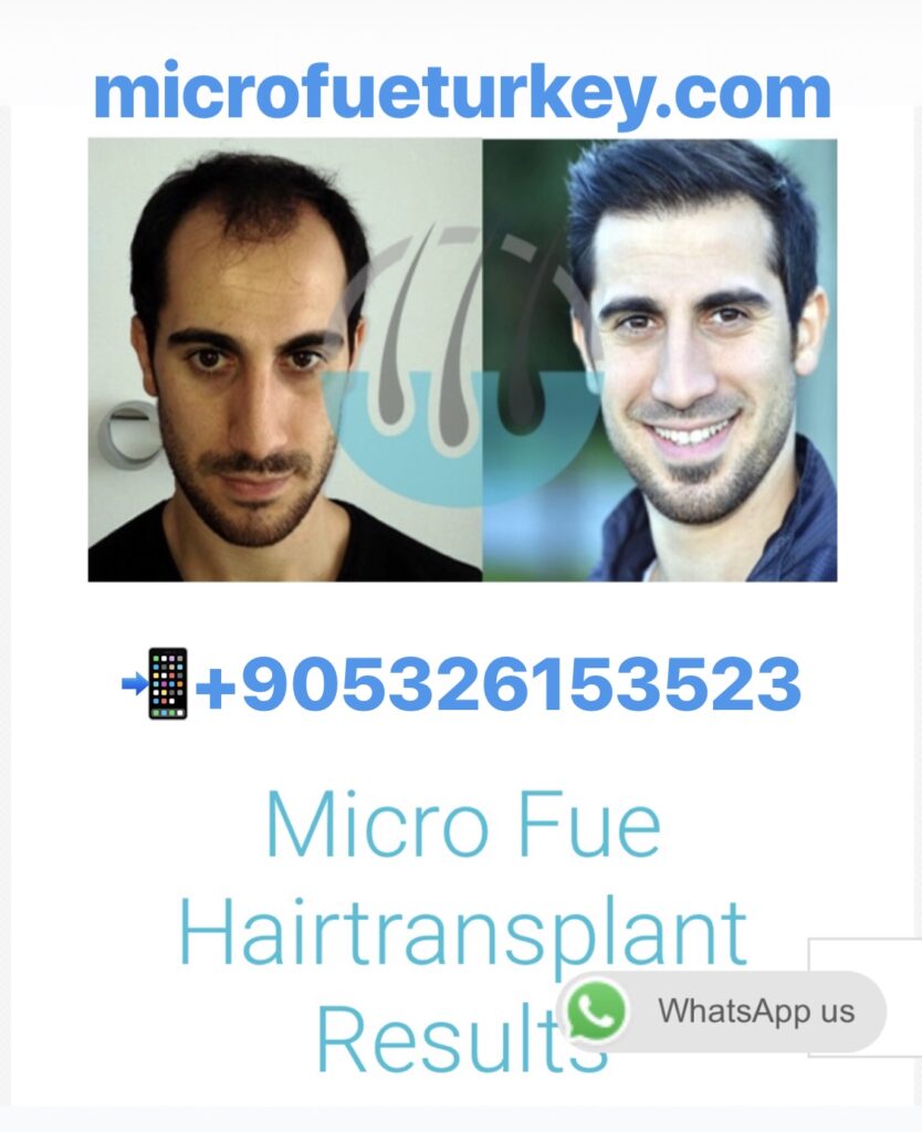 Plan Your Dream Holiday and Hair Transplant in Turkey with Micro FUE Turkey