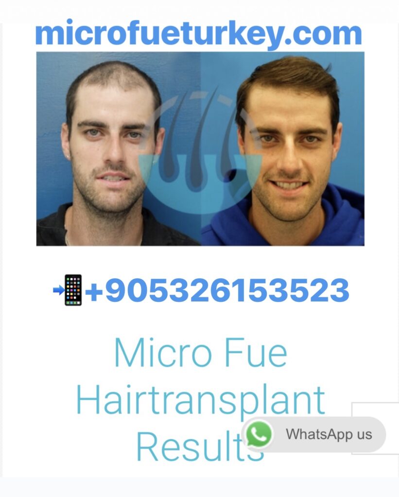 Best Hair Transplant Cities in Turkey