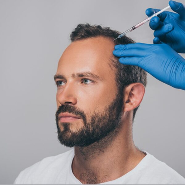 PRP Hair Treatment in London PRP Hair Treatment in London