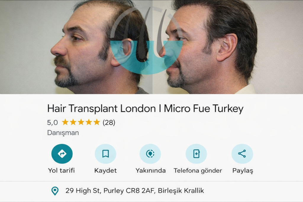 Hair Transplant London | Micro Fue Turkey UK 2026
