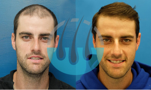 Hair Transplant UK Before After results showing natural hairline restoration and high-density FUE hair transplant outcome